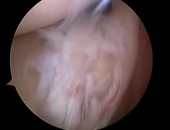 Superior Labrum Anterior to Posterior (SLAP) Tear