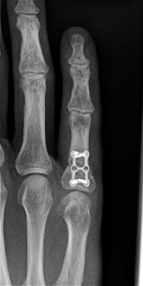 Fracture of proximal phalanx treated with mini titanium plate and 1.5mm screws