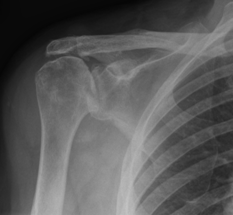 Radiograph of shoulder showing evidence of arthritis and rotator cuff tear