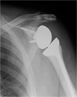 After a reverse polarity shoulder replacement