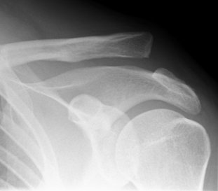 Displaced clavicle