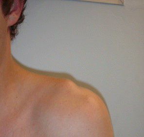 Clinical appearance of disruption of the acromioclavicular joint