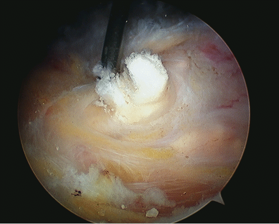 Arthroscopic removal of the toothpaste like material in calcifying tendinitis of the rotator cuff
